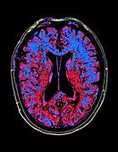 Human brain, axial MRI scan