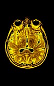 Human eyes and brain, axial MRI scan