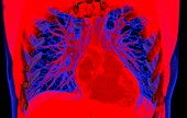 Heart and lungs, 3D CT scan