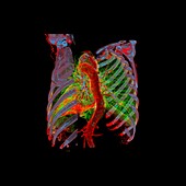 Aortic aneurysm, 3D CT scan