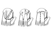 Rotator cuff repair shoulder surgery, illustration