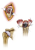 Doursounian implant shoulder surgery, illustration
