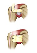 Iannotti procedure shoulder surgery, illustration