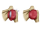 Rockwood disorder shoulder surgery, illustration