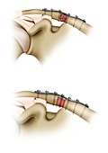 Clavicle fracture repair surgery, illustration