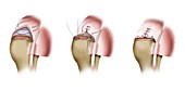 Sutures used in shoulder surgery, illustration
