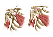 Shoulder muscles surgery, illustration
