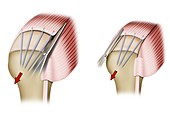 Rotator cuff shoulder surgery, illustration