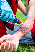 Medical worker treating burns on man's arm