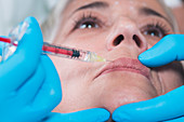 Woman having hyaluronic acid injections