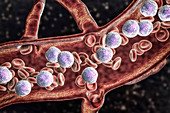 Acute lymphoblastic leukaemia, illustration