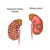 Polycystic kidney disease and kidney cancer, illustration