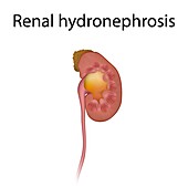 Renal hydronephrosis, illustration