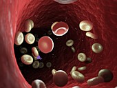 Diseased blood cells, illustration