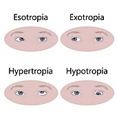 Childhood strabismus types, illustration