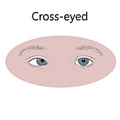 Cross-eyed child, illustration