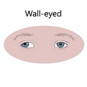Wall-eyed child, illustration