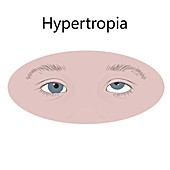 Childhood hypertropia, illustration