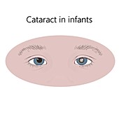 Childhood cataract, illustration