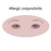 Allergic conjunctivitis, illustration
