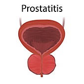 Prostatitis, illustration