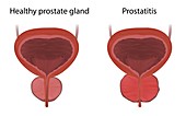 Prostatitis and healthy prostate gland, illustration