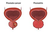 Prostate cancer and prostatitis, illustration