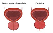 Benign prostatic hyperplasia and prostatitis, illustration