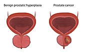 Cancer and benign prostatic hyperplasia, illustration