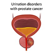 Urinary disorders with prostate cancer, illustration
