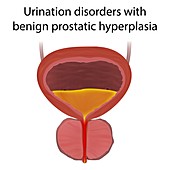 Urinary disorders with BPH, illustration