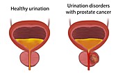 Urinary disorders and healthy urination, illustration