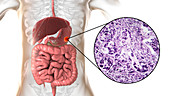 Human stomach cancer, illustration and light micrograph