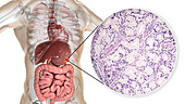 Human stomach cancer, illustration and light micrograph