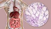 Human stomach cancer, illustration and light micrograph