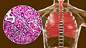 Miliary tuberculosis, illustration and light micrograph
