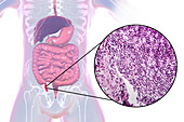 Acute appendicitis, illustration and light micrograph