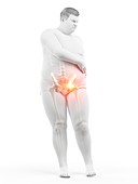 Obese man with hip pain, illustration