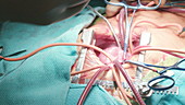 Heart transplant surgery