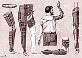 Prostheses by French surgeon Ambroise Pare, 16th century