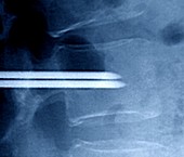 Vertebral augmentation in metastatic cancer, X-ray