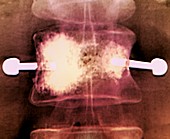 Vertebral augmentation in metastatic cancer, X-ray