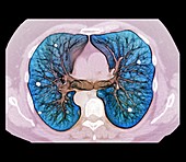 Secondary lung cancer, 3D CT scan