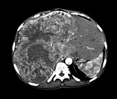 Liver cancer, CT scan