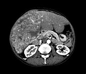 Liver cancer, CT scan