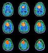 Meningioma brain tumour, MRI