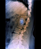 Spinal fracture, X-ray