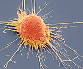 Prostate cancer cell, SEM