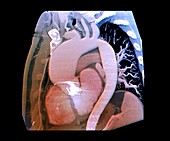 Thoracic aortic aneurysm, CTA scan