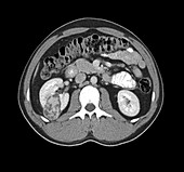 Renal cancer, CT scan